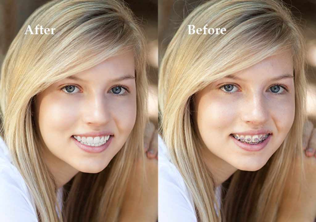 Braces_Removal_Before-After.jpg
